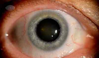 Краплі для очей Мезатон: інструкція із застосування очних крапель, показання, пріменнеіе