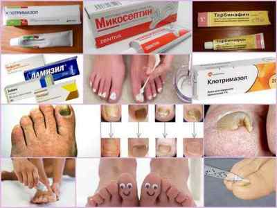 Креми і мазі від грибка нігтів на ногах - огляд кращих засобів