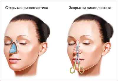 Кривий ніс: причини викривлення і методи виправлення
