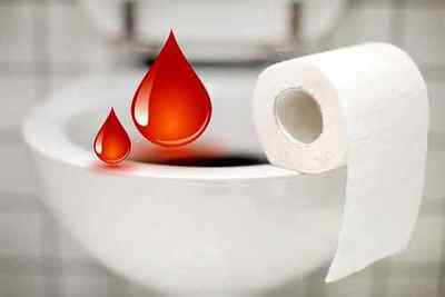 Кров при дефекації: найбільш часті причини і методи діагностики