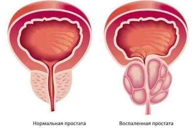 Кров при сечовипусканні у жінок і чоловіків