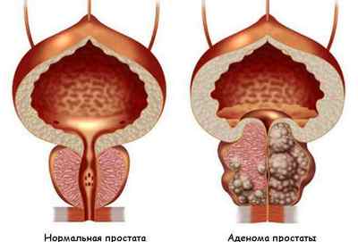 Кров в сечі (гематурія) у жінок і чоловіків: причини і лікування