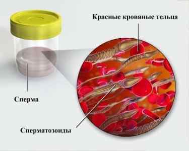 Кров в спермі (гемоспермія): причини і лікування