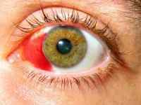 Крововилив в око: причини і лікування, що робити, лікування склоподібного тіла