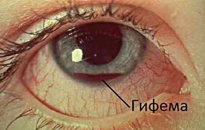 Крововилив в око: причини і лікування, що робити, лікування склоподібного тіла