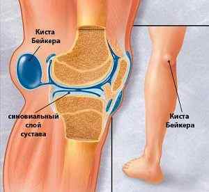 Кіста Бейкера колінного суглоба: що це таке і розміри для операції, відгуки та фото | Ревматолог