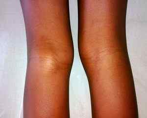 Кіста Бейкера колінного суглоба: що це таке і розміри для операції, відгуки та фото | Ревматолог