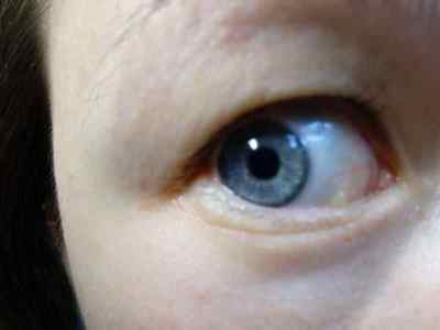 Кіста конюнктиви на оці: причини, лікування слізної залози і рогівки очного яблука