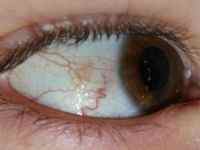 Кіста конюнктиви на оці: причини, лікування слізної залози і рогівки очного яблука