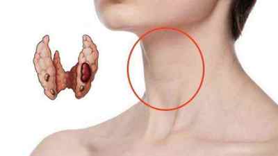 Кіста щитовидної залози: лікування і симптоми