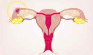 Кіста яєчника при вагітності: причини і лікувальні заходи