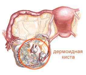 Кіста яєчника при вагітності: причини і лікувальні заходи