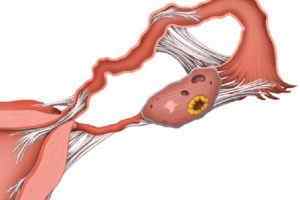 Кіста яєчника в менопаузі: види, причини, лікування і симптоми