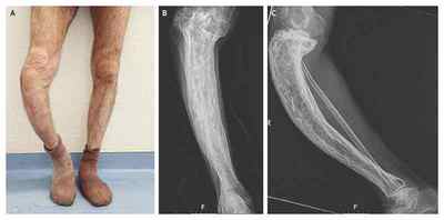Кісткова хвороба Педжета: симптоми і лікування, що це таке і фото кісток таза | Ревматолог