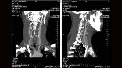 КТ хребта: що це таке, що краще КТ або МРТ і чим відрізняється, що показує томографія хребта, СКТ | Ревматолог