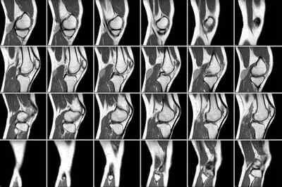 КТ колінного суглоба: що показує компютерна томографія кісток і суглобів коліна, що краще КТ або МРТ і чим відрізняється | Ревматолог