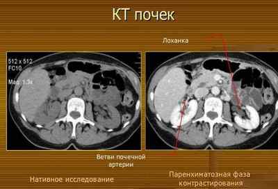 КТ нирок (компютерна томографія) з контрастуванням і без контрасту
