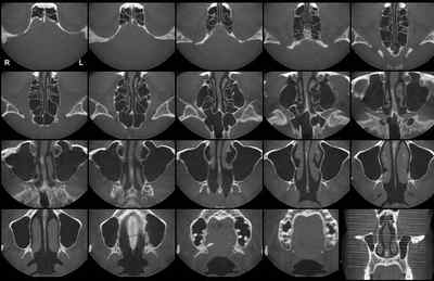 КТ придаткових пазух носа (компютерна томографія): що показує, як проводиться, як часто можна робити КТ носа і близько носових пазух