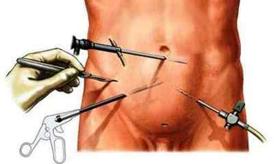 Лапароскопічна операція при варикоцеле: переваги операції