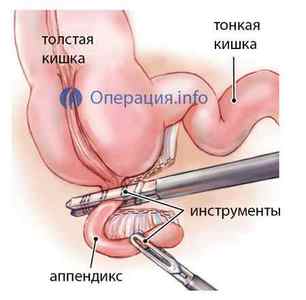 Лапароскопія апендициту (лапароскопічне видалення апендикса)