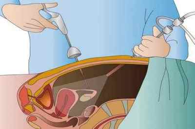 Лапароскопія кісти яєчника: особливості процедури, відгуки