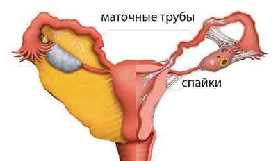 Лапароскопія маткових труб: операція і її проведення