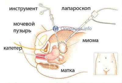 Лапароскопія міоми матки (лапароскопічне видалення)
