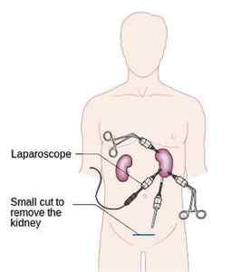 Лапароскопія нирки (лапароскопічна операція): суть і хід, реабілітація