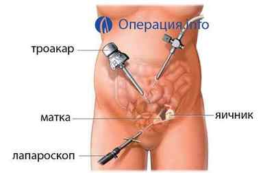 Лапароскопія: операція і її застосування (в гінекології, черевної порожнини)