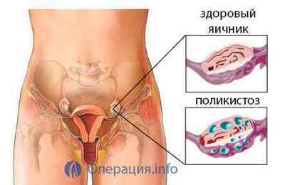 Лапароскопія яєчника при кісті /полікистозе /безплідді і ін.