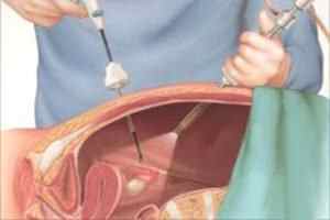 Лапароскопія жовчного міхура: показання та протипоказання, підготовка і реабілітація