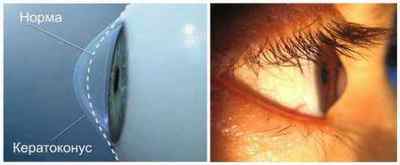 Лазерна корекція зору на очі: відгуки, плюси і мінуси, боляче робити операцію