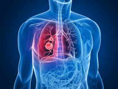 Легенева кровотеча: симптоми, причини і лікування