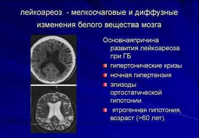 Лейкоареоз головного мозку перивентрикулярний, симптоми і лікування