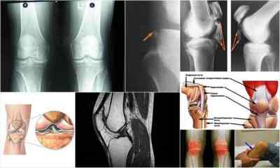 Лігаментоз колінного суглоба: що це таке, причини, симптоми, лікування