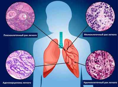 Ліки від раку легенів: список препаратів і методів лікування