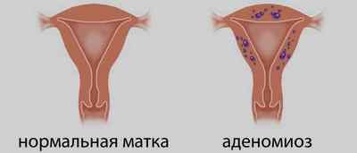 Лікування аденоміозу матки Дюфастоном: особливості впливу, інструкція