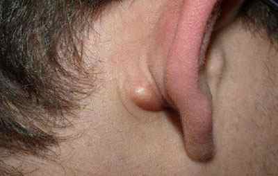 Лікування атероми за вухом і на мочці вуха