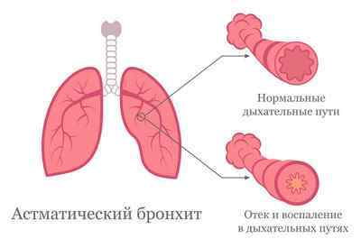 Лікування бронхіальної астми у дітей з Комаровскому