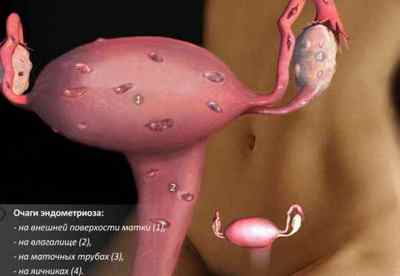 Лікування ендометріозу матки у жінок