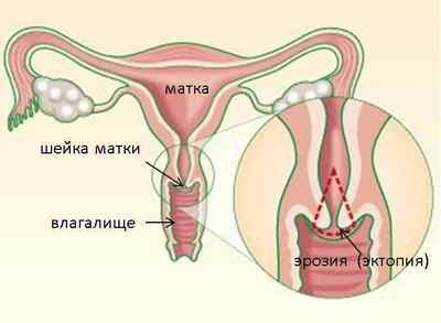 Лікування ерозії шийки матки при вагітності