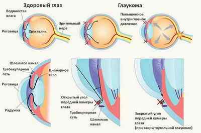 Лікування глаукоми народними засобами: як лікувати в домашніх умовах без операції, відгуки