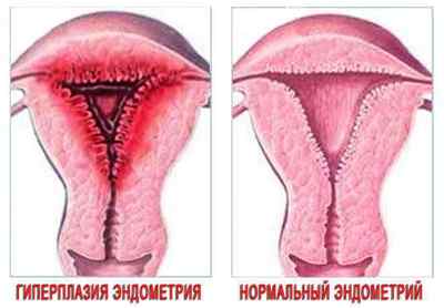 Лікування гіперплазії ендометрія і міоми матки