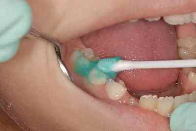 Лікування карієсу молочних зубів у дітей раннього віку - профілактика