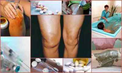 Лікування колінного суглоба в домашніх умовах: медикаменти, гімнастика, народні рецепти