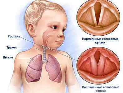 Лікування ларингіту у дітей по лікаря Комаровського