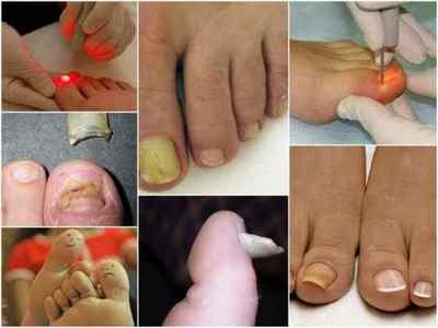 Лікування лазером грибка нігтів на ногах: ефективність, протипоказання, ціна, відгуки
