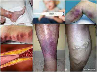 Лікування лазером варикозу вен на ногах - ціна, відгуки, переваги та недоліки лазерної коагуляції