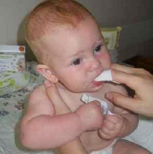 Лікування молочниці в роті у дітей - все методи