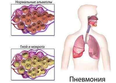 Лікування пневмонії народними засобами - найпопулярніші рецепти